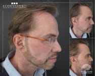 La micropigmentation capillaire: qu&rsquo;est-ce que c&rsquo;est ?