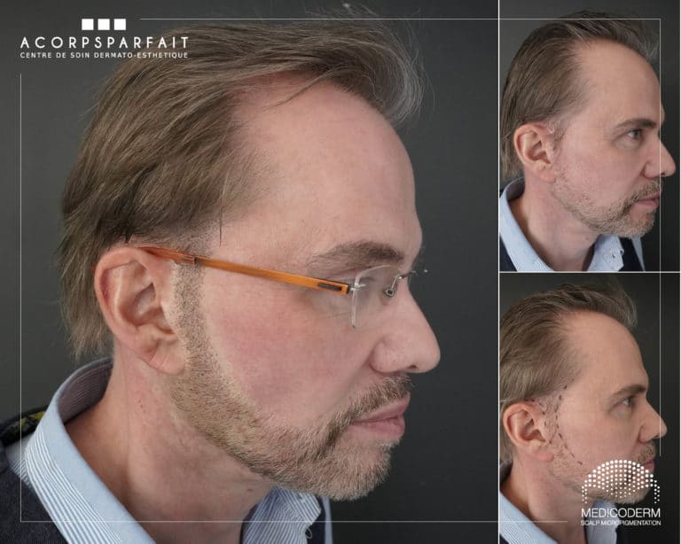 La micropigmentation capillaire: qu&rsquo;est-ce que c&rsquo;est ?